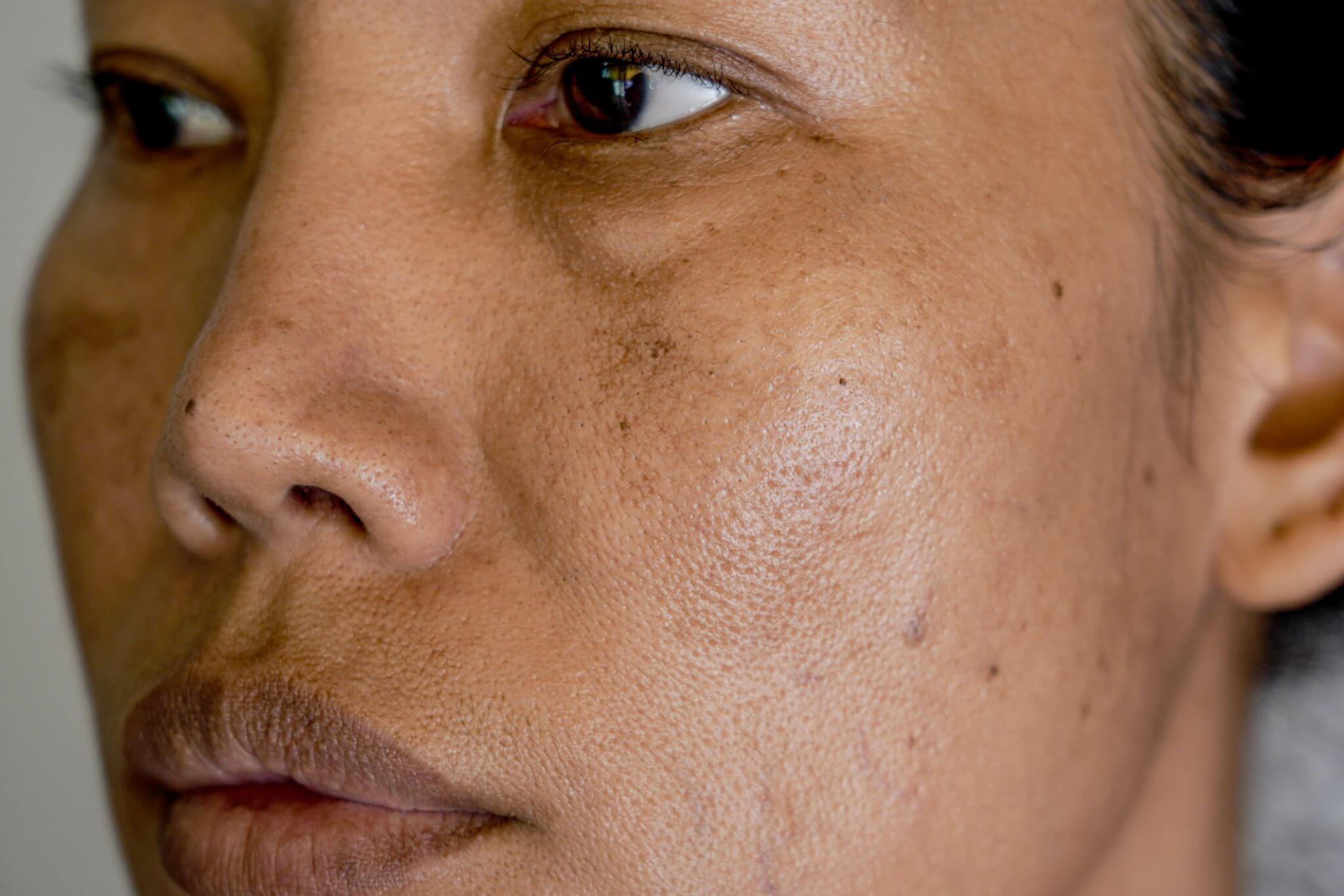 Close-up of a woman's face with freckles.