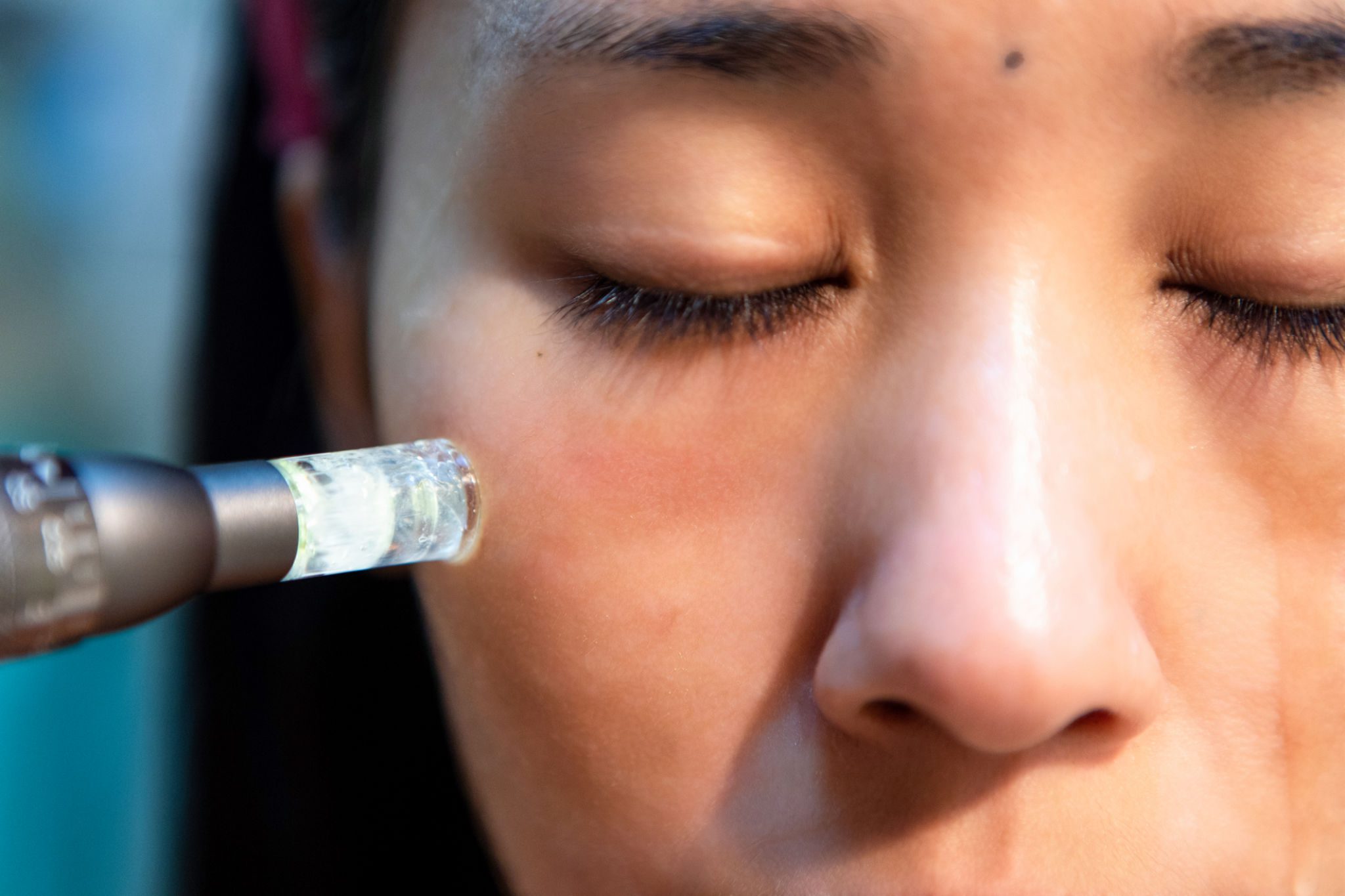 Facial treatment with microdermabrasion tool.