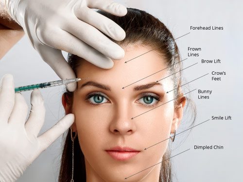 A woman receiving a cosmetic botox injection with facial muscle labels.