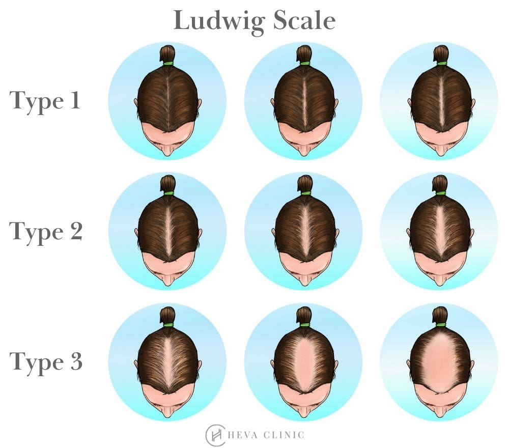 female_pattern_hair_loss-20260713121851