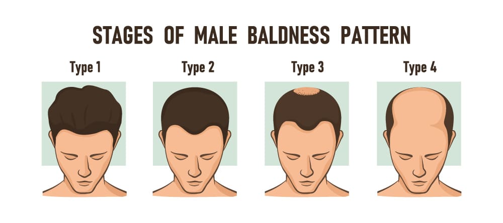male-pattern-baldness-stages-20260713121923
